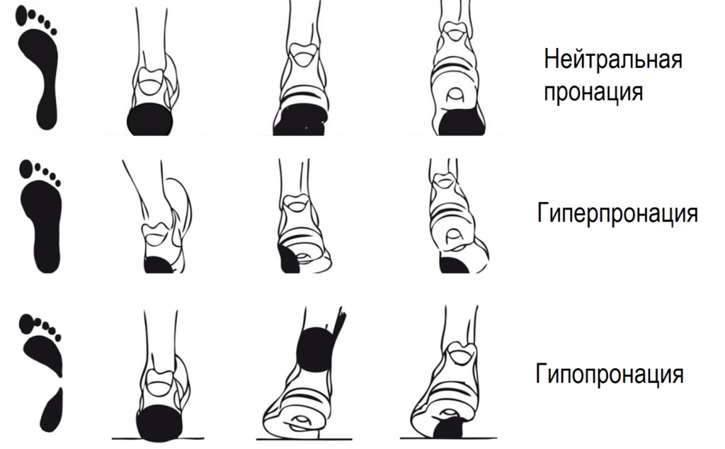степени пронации стопы